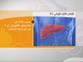 مرض التهاب الكبد الوبائي يصيب اكثر من 25% من المصريين